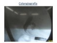 /album/ubicacion-aberrante-de-papila/asenda-papila-bulboduodenal-1-6-jpg/